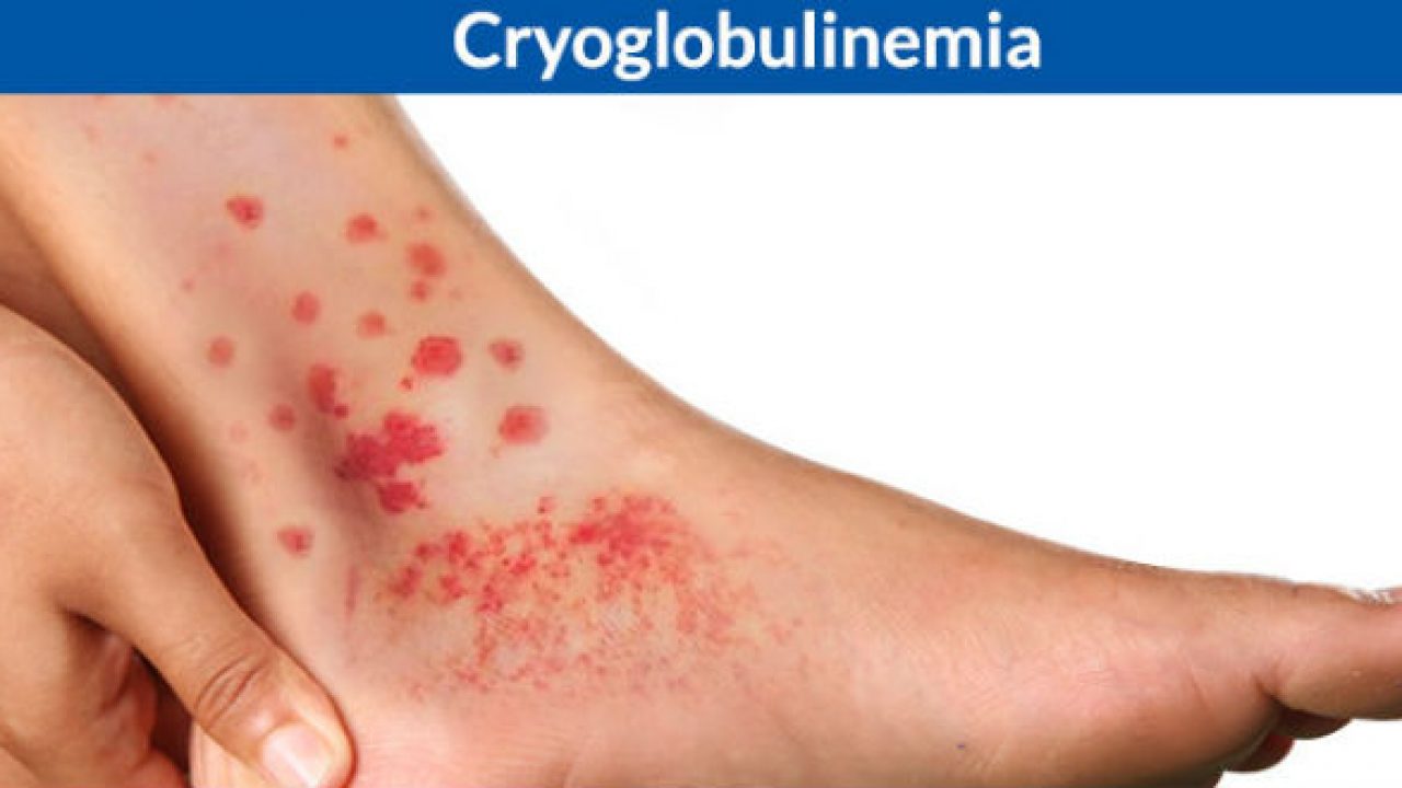 Cryoglobulin – Căn bệnh hiếm gây xuất huyết dưới da và tổn thương dây thần kinh ngoại biên