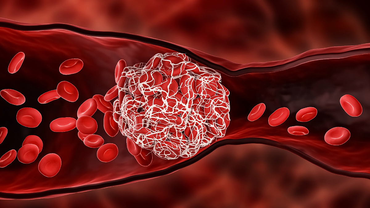 Cục máu đông trong tĩnh mạch: Nguyên nhân, biểu hiện, cách điều trị