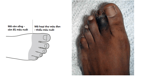 Ngón chân bị hoại tử càng chủ quan càng dễ chết