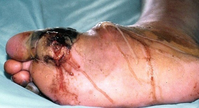 Dấu hiệu ngón chân bị hoại tử và cách điều trị theo Đông y