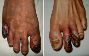 Bệnh hoại tử ngón chân: Nguyên nhân, biểu hiện, cách điều trị