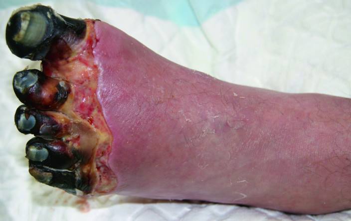 Bàn chân bị hoại tử ở bệnh nhân đái tháo đường có nguy hiểm không?