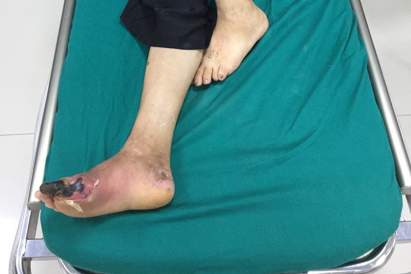 Triệu chứng hoại tử chân cần nhận biết sớm tránh cắt cụt chi