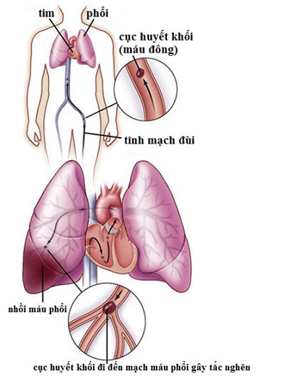 Điều trị tắc mạch phổi theo phác đồ của bác sĩ chuyên khoa mạch máu