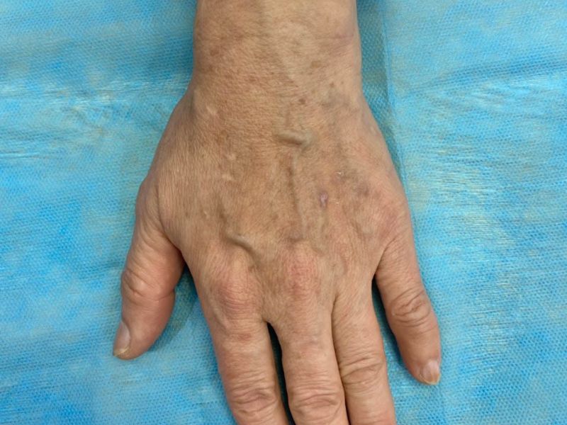 Giãn tĩnh mạch ở tay là bệnh gì? Có điều trị được không?