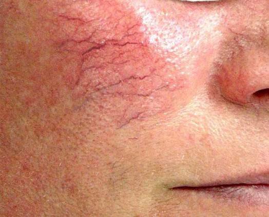Da mặt bị giãn tĩnh mạch có phải là bệnh không? Làm sao để  phục hồi?