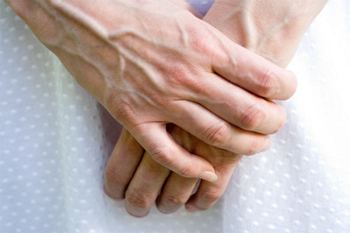 Giãn tĩnh mạch bàn tay không đau có cần điều trị không?