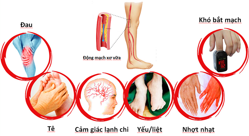 Bệnh động mạch ngoại biên chi dưới gây lở loét chân do thiếu máu chi dưới