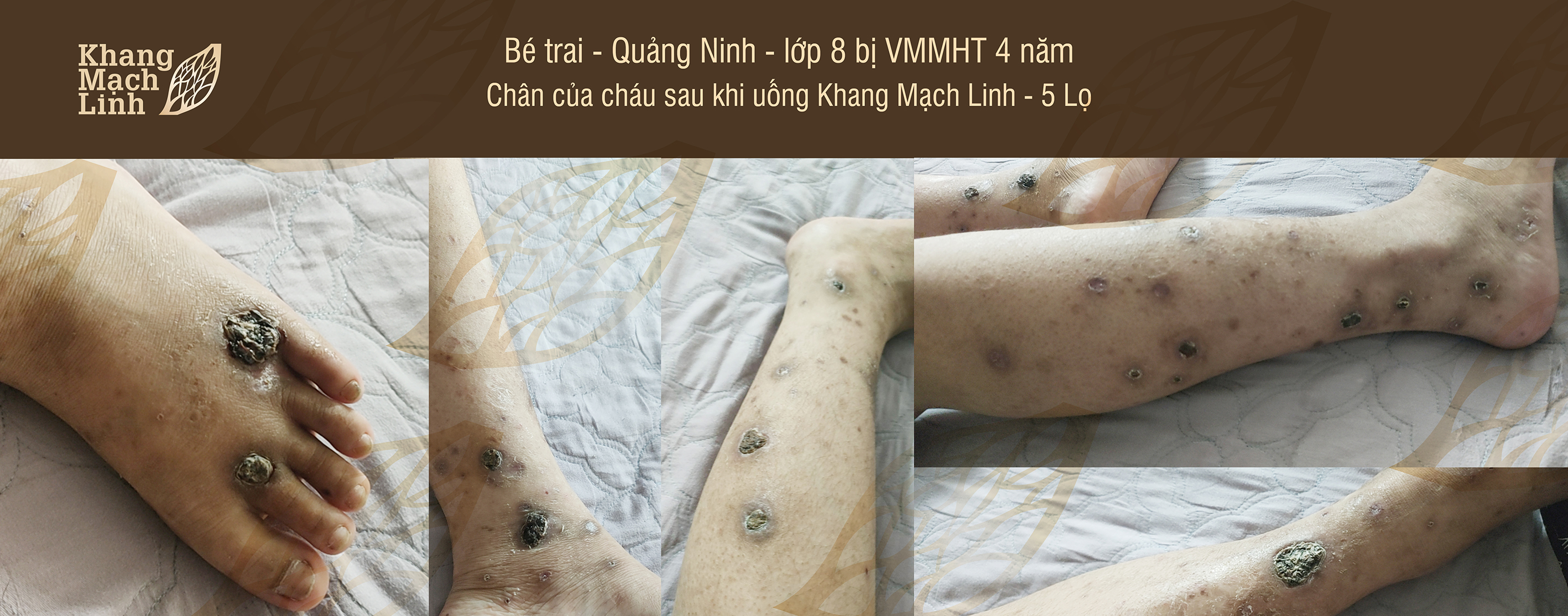 Kinh nghiệm điều trị viêm mao mạch hoại tử