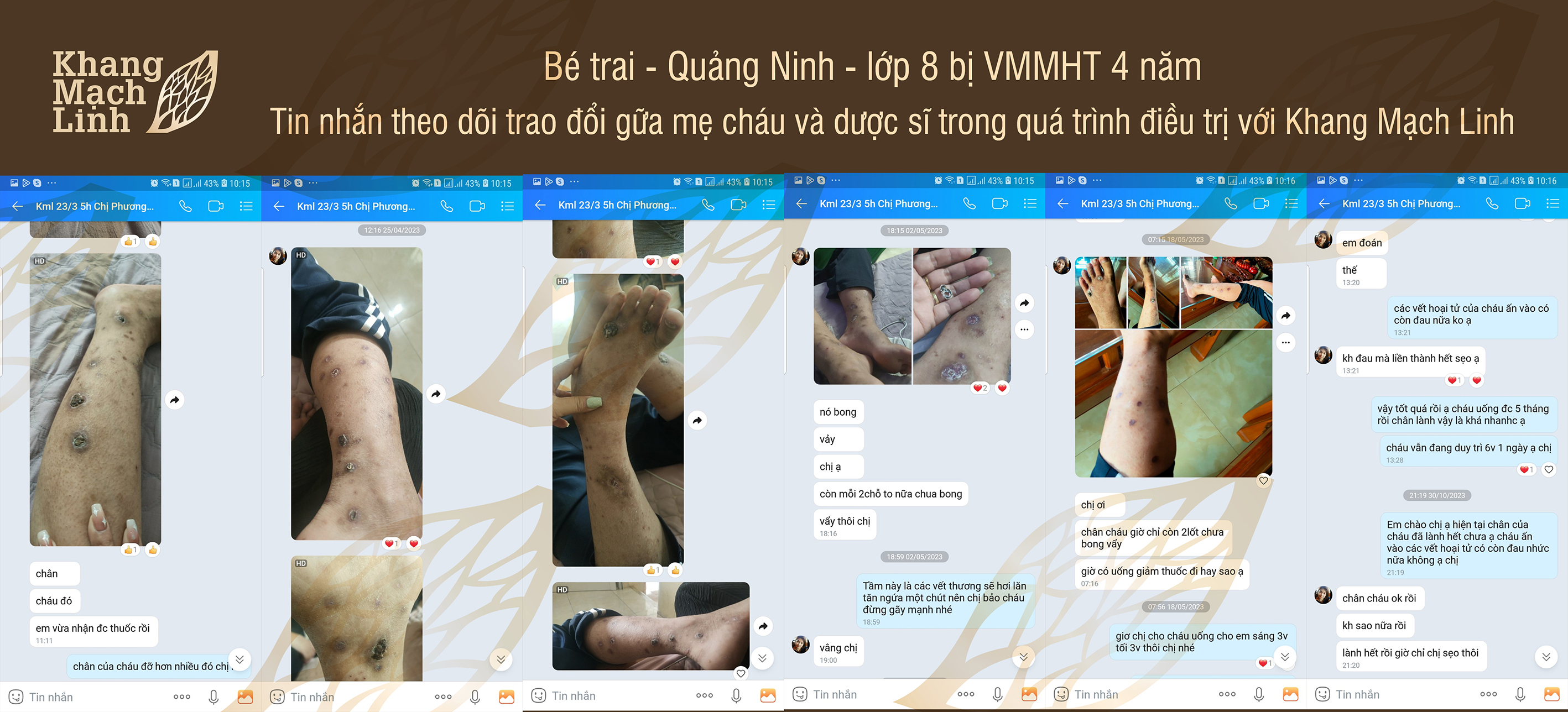 Kinh nghiệm điều trị viêm mao mạch hoại tử