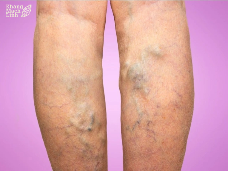 Suy giãn tĩnh mạch