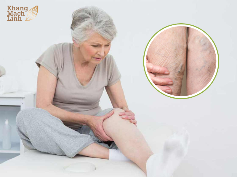 Suy giãn tĩnh mạch do tuổi tác