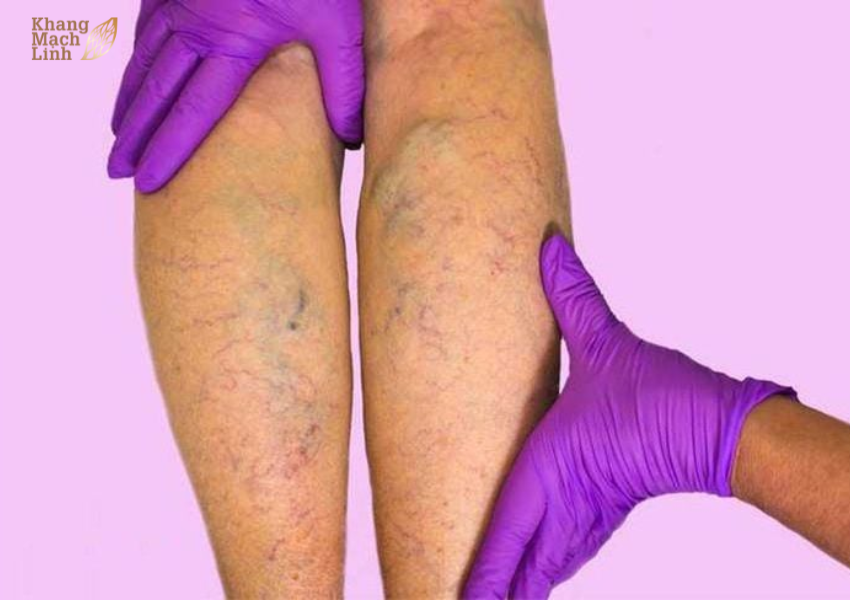 Viêm tắc tĩnh mạch