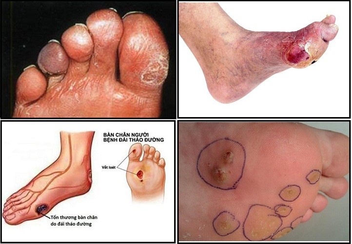 Phương pháp điều trị bệnh lý về bàn chân do đái tháo đường
