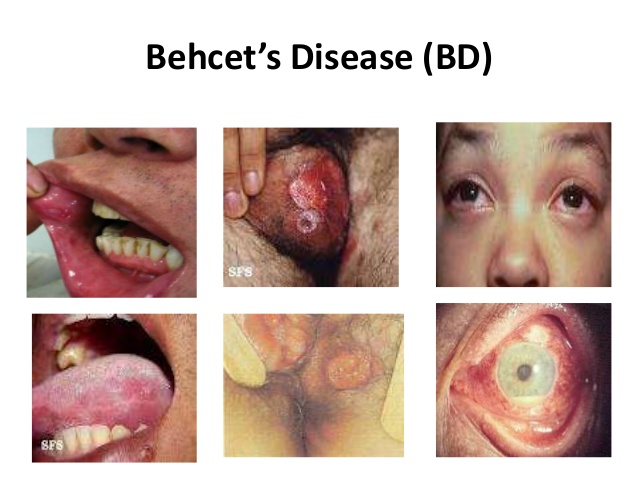 Phương pháp điều trị hội chứng Behcet bằng Đông y