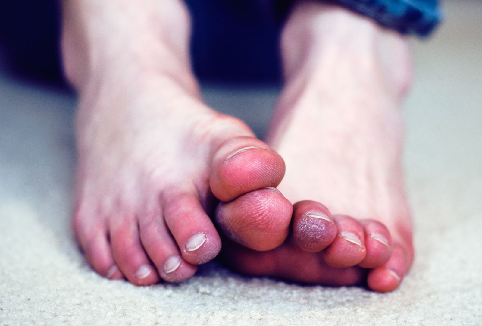 Bàn chân lạnh có phải triệu chứng bệnh lý tĩnh mạch không?