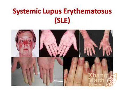 Phân biệt viêm mao mạch dị ứng và Lupus ban đỏ