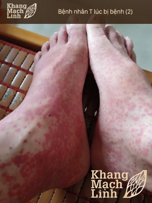 Tổn thương hệ tiêu hóa do viêm mao mạch dị ứng nghiêm trọng như thế nào?