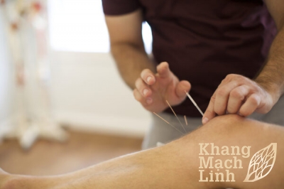 Suy giãn tĩnh mạch có châm cứu được không? Lợi và hại mà bạn chưa biết