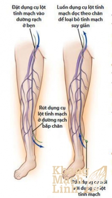 Cách chữa suy giãn tĩnh mạch theo lời khuyên của bác sĩ chuyên gia mạch máu