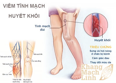Nghẽn tĩnh mạch chân đừng nhầm lẫn với suy giãn tĩnh mạch