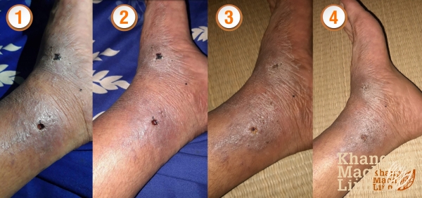 Bệnh sâu quảng không còn đáng sợ nhờ điều trị theo phương pháp Đông Y