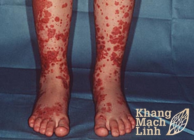Viêm mạch dị ứng gây biến chứng viêm cầu thận