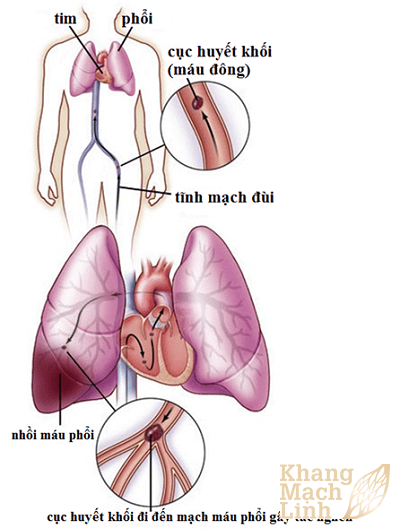 Tắc mạch phổi 