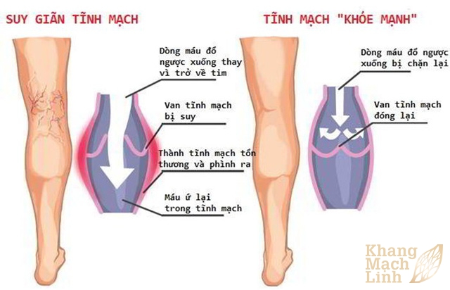 Giãn tĩnh mạch ở tuổi dậy thì