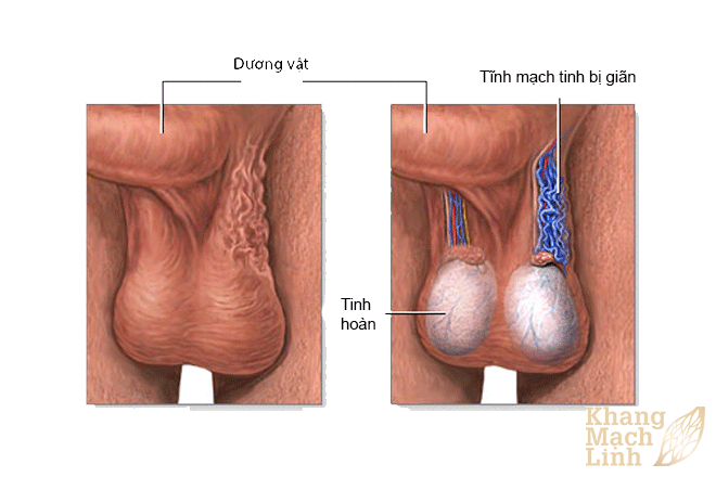 Giãn tĩnh mạch ở tuổi dậy thì