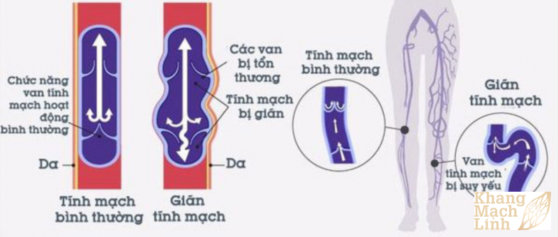 Thuốc đông y trị suy giãn tĩnh mạch 