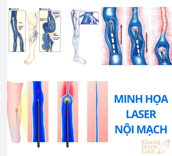 Điều trị bệnh giãn tĩnh mạch