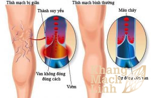 Bơi lội giúp tăng cường sức khỏe tĩnh mạch