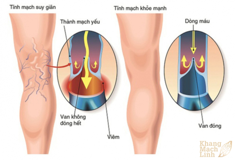 Giãn tĩnh mạch khoeo chân