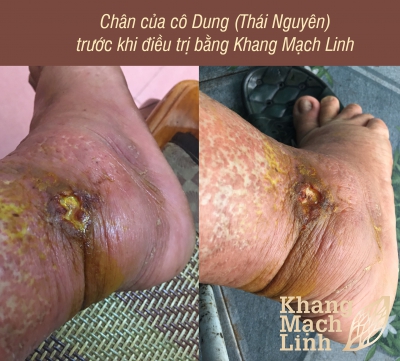 TÔI TƯỞNG CHẾT VÌ ĐAU ĐỚN, LỞ LOÉT CHÂN, CHẢY MÁU MỦ CẢ NĂM TRỜI