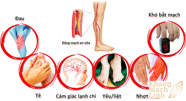 Bệnh động mạch ngoại biên chi dưới gây lở loét chân do thiếu máu chi dưới