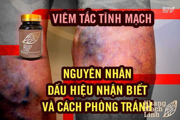 Viêm tắc tĩnh mạch: Nguyên nhân, dấu hiệu nhận biết và cách phòng tránh
