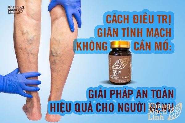 Cách điều trị giãn tĩnh mạch không cần mổ: Giải pháp an toàn, hiệu quả cho người bệnh