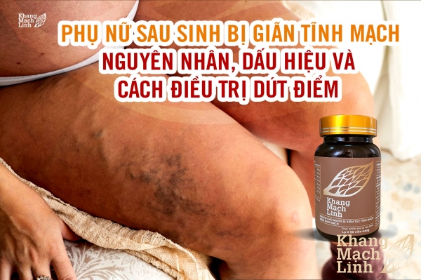 Phụ nữ sau sinh bị giãn tĩnh mạch: Nguyên nhân, dấu hiệu và cách điều trị dứt điểm
