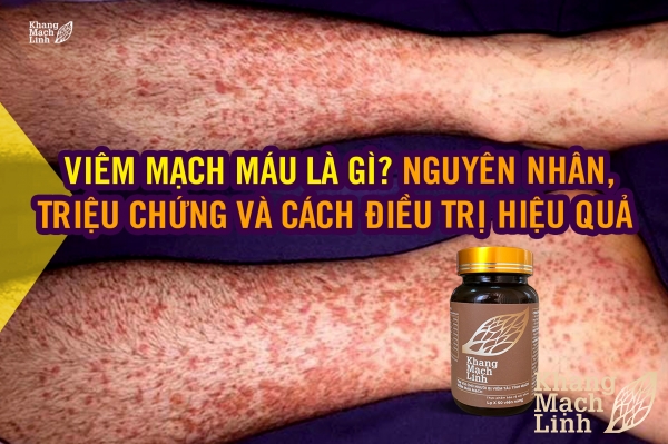 Viêm mạch máu là gì? Nguyên nhân, triệu chứng và cách điều trị hiệu quả