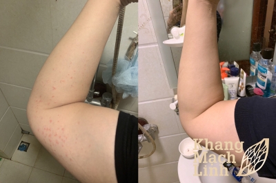 Chàng trai trẻ Hà Nội và bí quyết thoát khỏi viêm mao mạch dị ứng