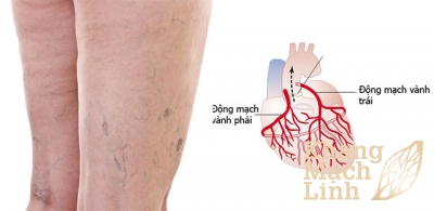 Viêm tắc, suy giãn tĩnh mạch có liên quan đến động mạch vành