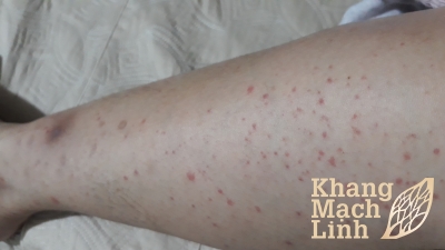 Chân con bị nốt ban đỏ mẹ phát hoảng vì bệnh mao mạch dị ứng