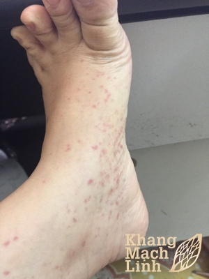 Thảo dược có vai trò quan trọng đối với bệnh dị ứng
