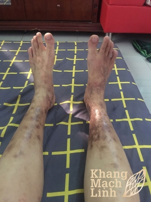 Chú T bị viêm mao mạch dị ứng gần 10 năm