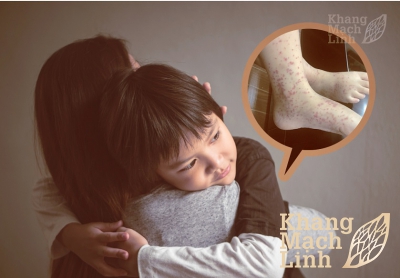 Trẻ em bị viêm mao mạch dùng Khang Mạch Linh liều như thế nào?