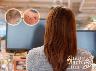 Tôi đã kiên trì và vượt qua bệnh viêm mao mạch hoại tử rồi!