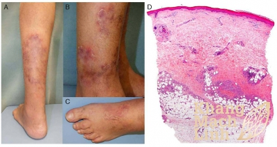 Bệnh viêm đa động mạch nút: Từ A đến Z những điều cần biết