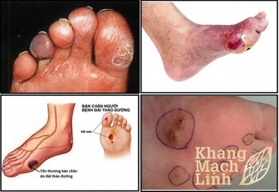 Phương pháp điều trị bệnh lý về bàn chân do đái tháo đường