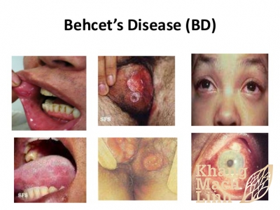 Phương pháp điều trị hội chứng Behcet bằng Đông y